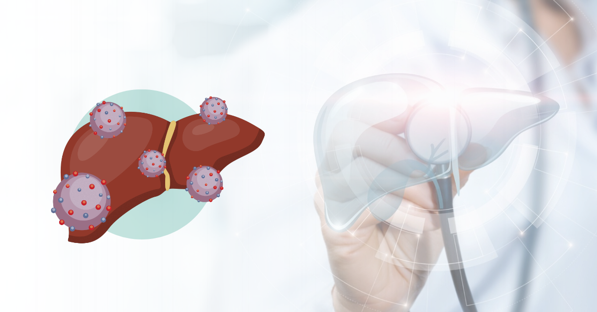 Top 5 Technologies used for Liver Cancer Treatment